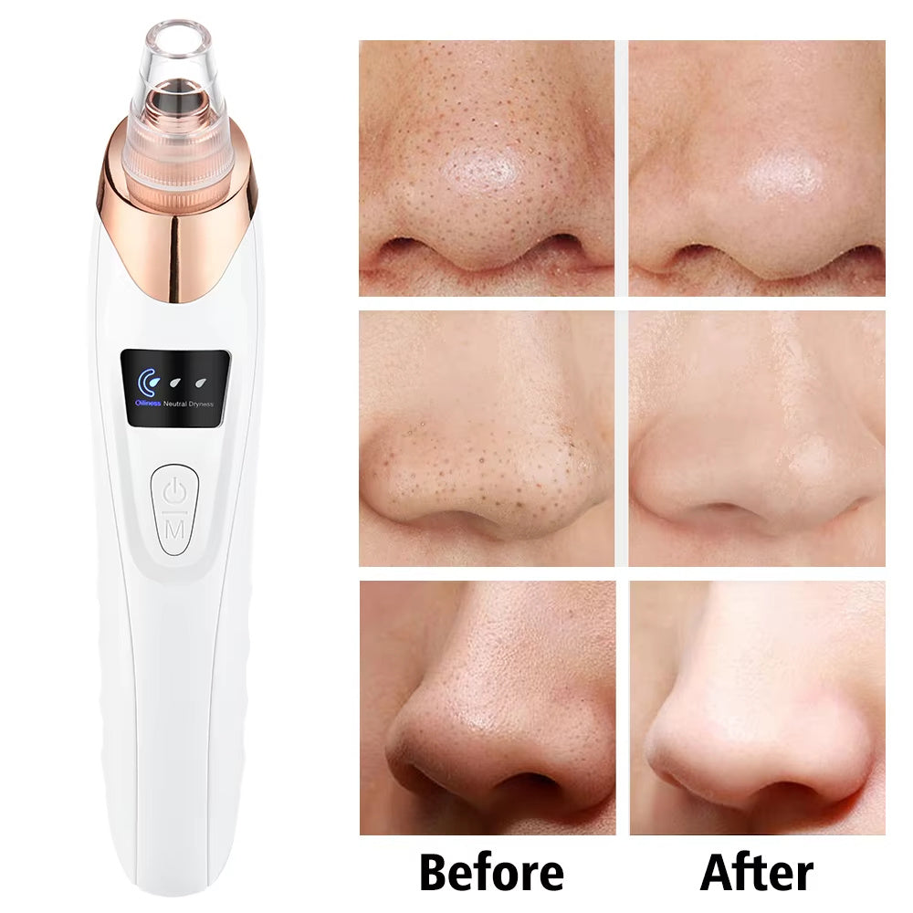 Electric Professional Blackhead Remover Black Pimple Blemish Beauty Women Skin Care Facial Cleaning Pimple Remover Tool Kit Electric Professional Blackhead Remover Black Pimple Blemish Beauty Women Skin Care Facial Cleaning Pimple Remover Tool Kit